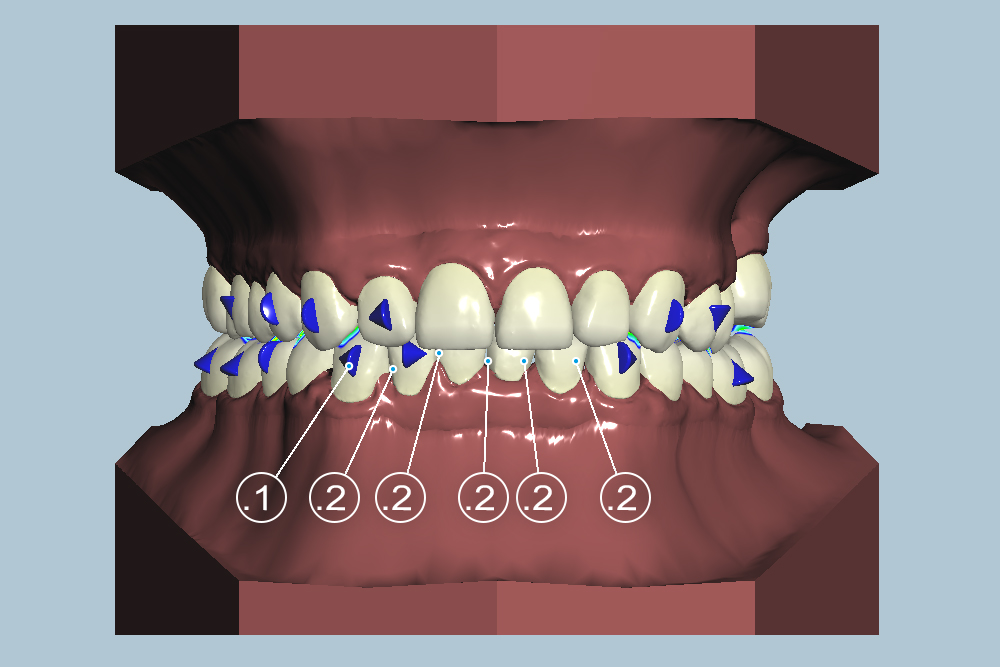 033_sdl_sunclear_aligner sunclear aligners behandlungsplan