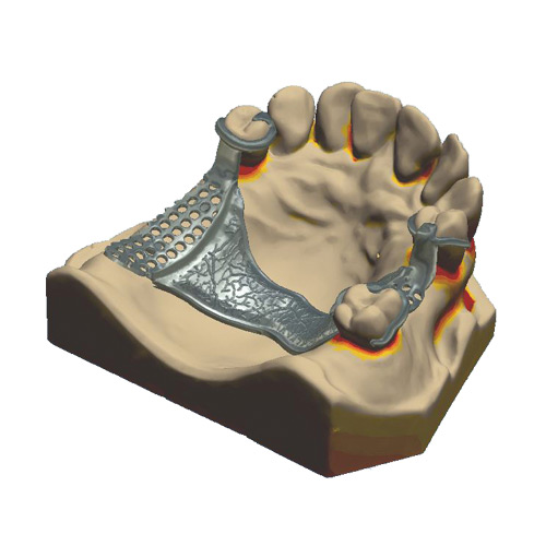 CAD/CAM Modellguss NEM oder PEEK